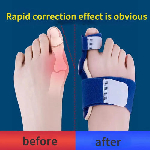 Orthopaedic Bunion Corrector